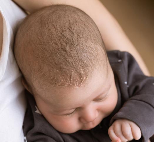 La peau des bébés est particulièrement fragile et certains composants